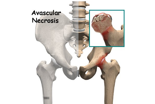 Avascular Necrosis