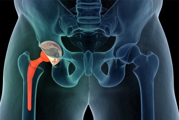 Total Hip Replacement