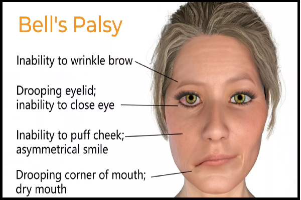 Bells Palsy